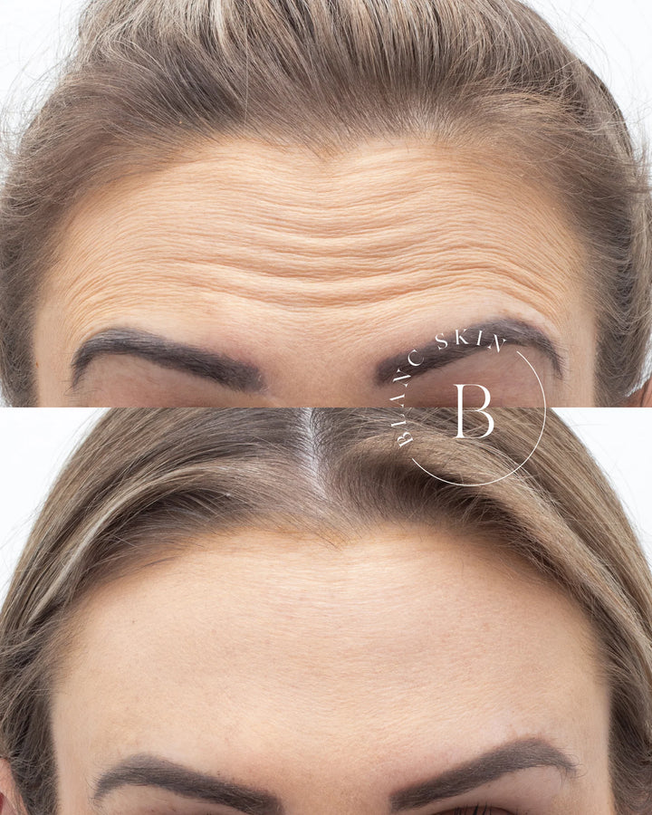 botox perth anti wrinkle injections