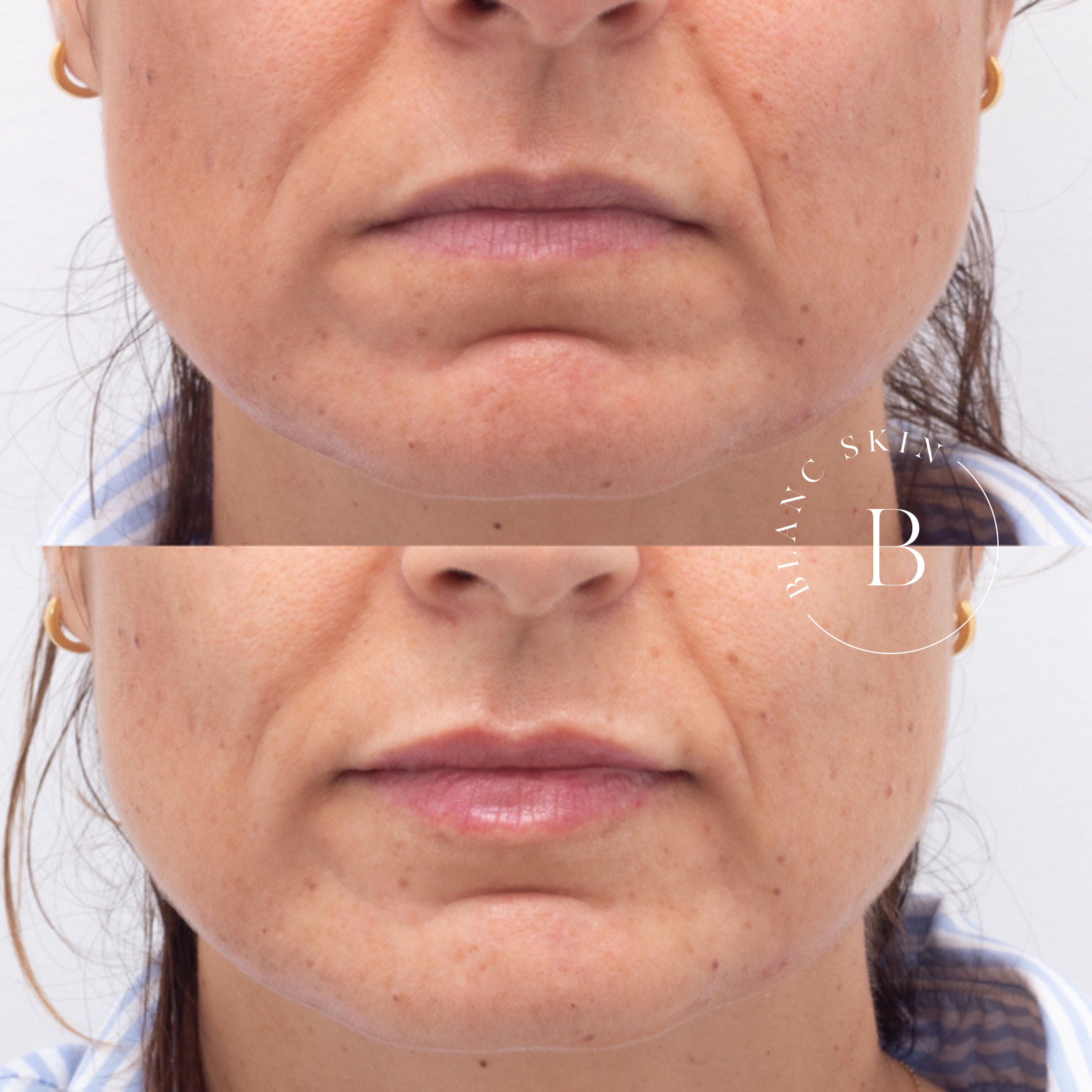 Dermal Fillers Perth - Cosmetic Injectables | BLANC Skin