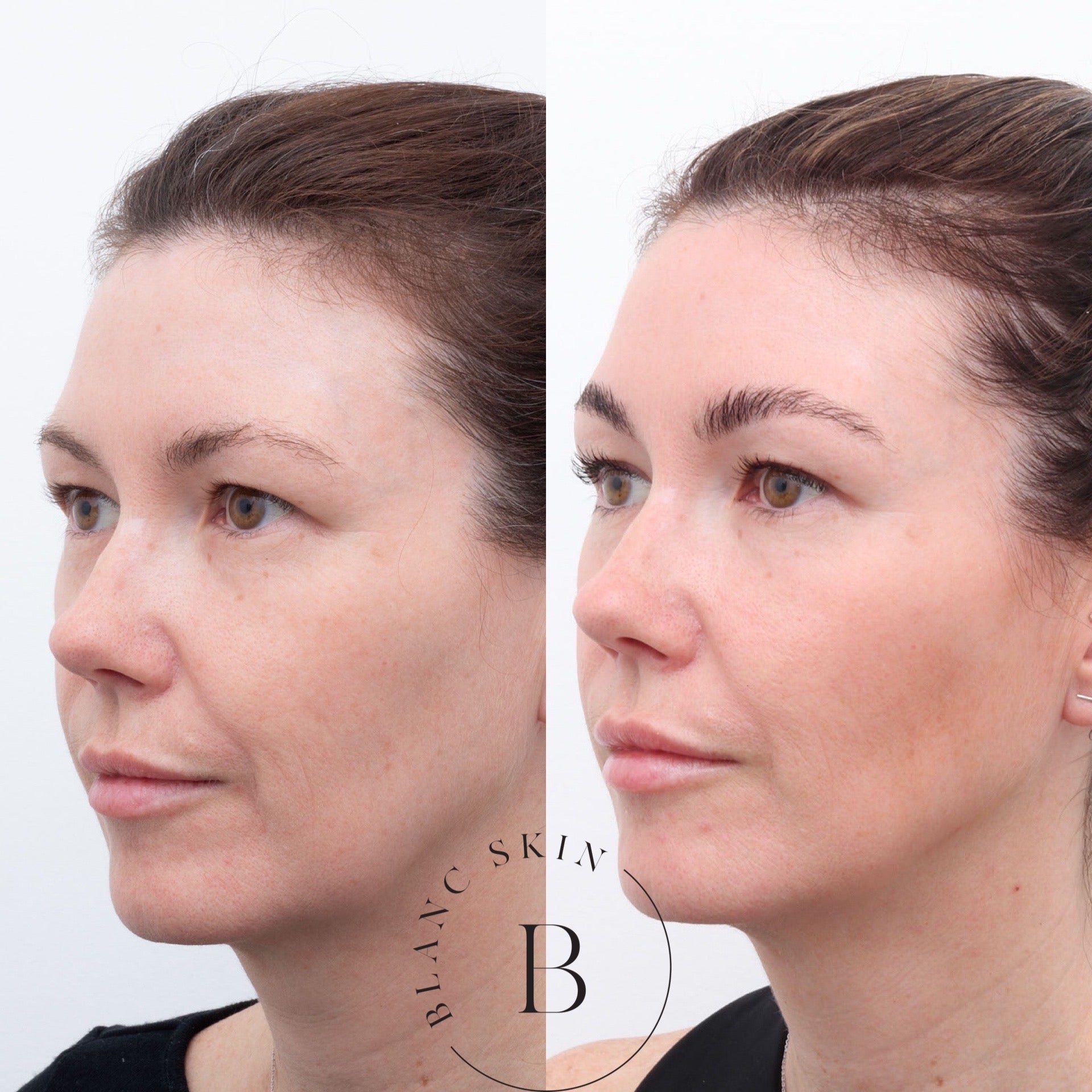 Thread Lift Perth NonSurgical Face Lift BLANC