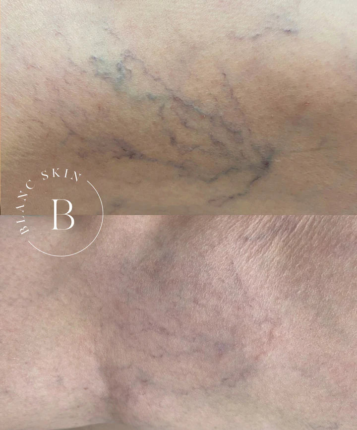 excel v laser treatment perth