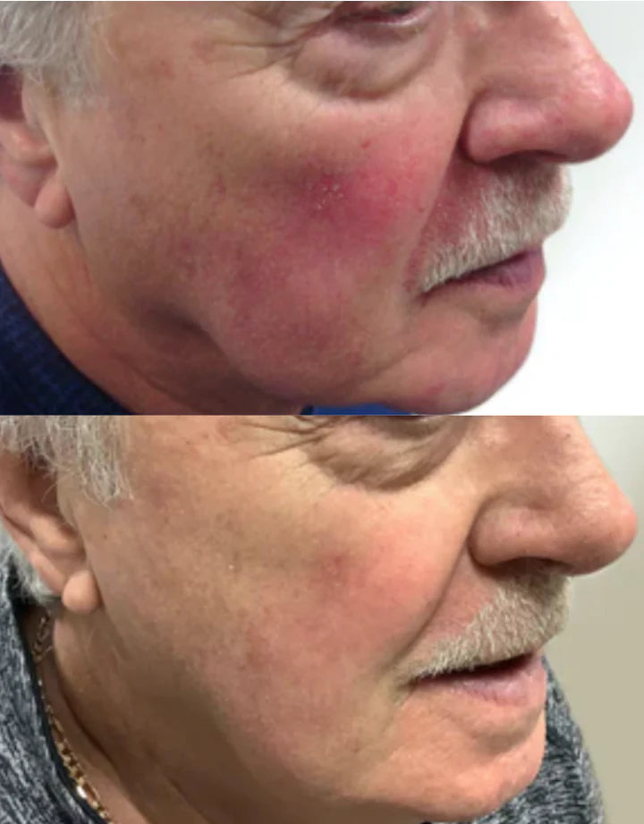 excel v laser treatment perth