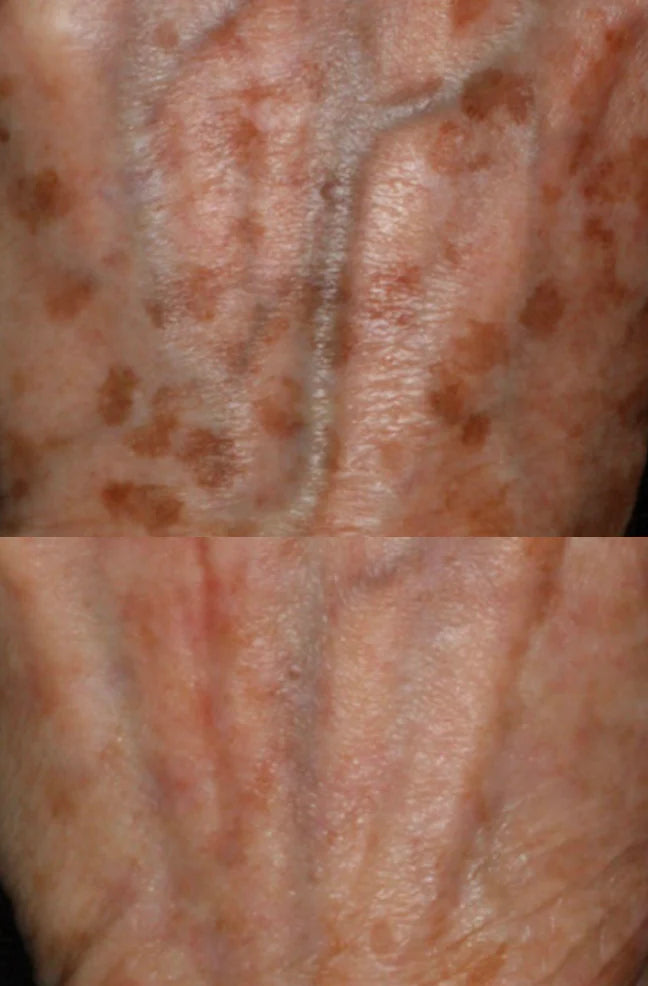 excel v laser treatment perth