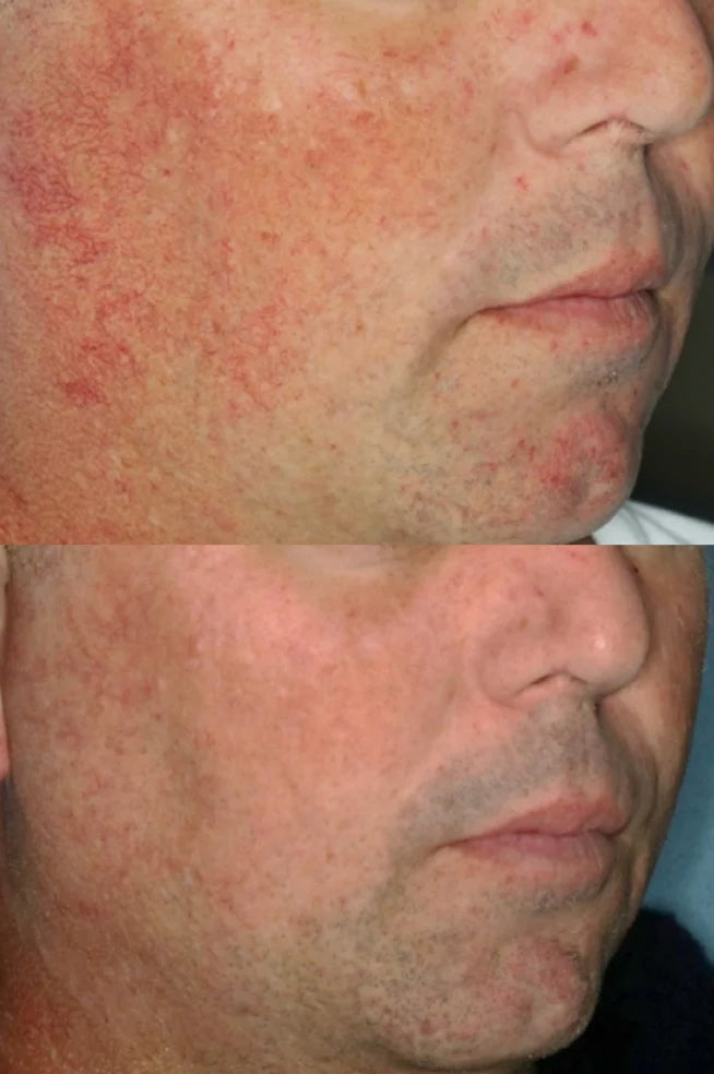excel v laser treatment perth