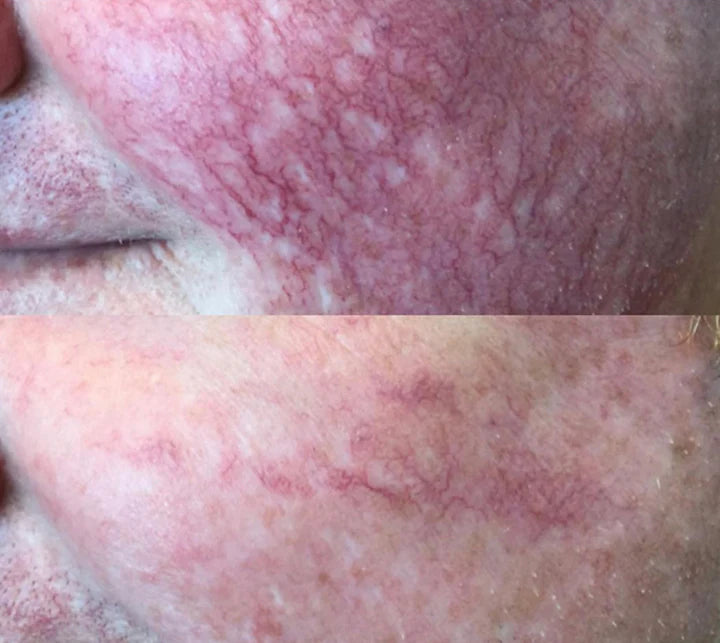 excel v laser treatment perth