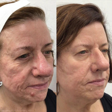 morpheus8 perth fractional rf microneedling