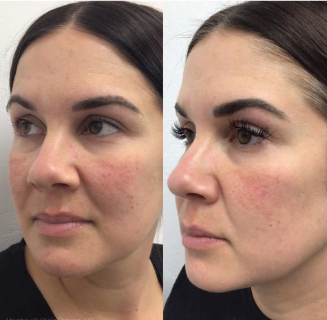 morpheus8 perth fractional rf microneedling