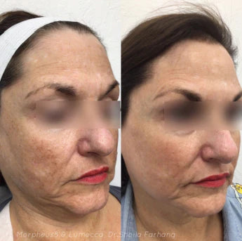 morpheus8 perth fractional rf microneedling