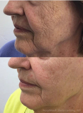 morpheus8 perth fractional rf microneedling