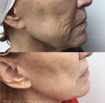 morpheus8 perth fractional rf microneedling